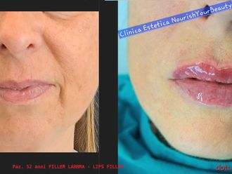 Filler labbra prima e dopo - 874782