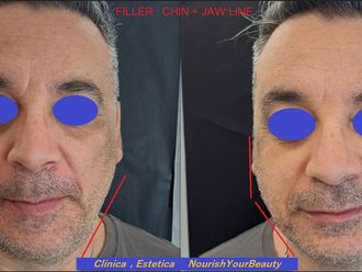 Acido ialuronico prima e dopo - 874923