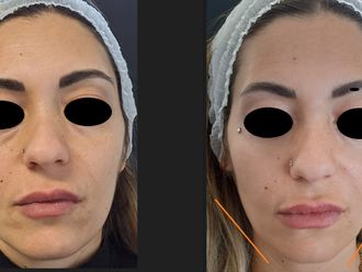 Biostimolazione prima e dopo - 874924