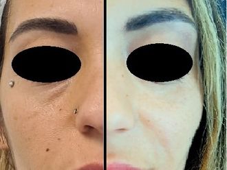 Biostimolazione prima e dopo - 875015
