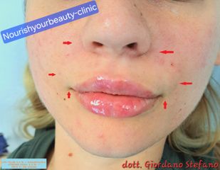 Filler zona periorale e labbra