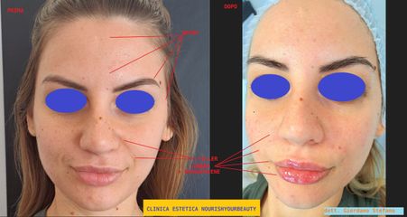 Botox+Filler labbra