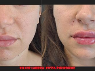 Filler labbra prima e dopo - 875127