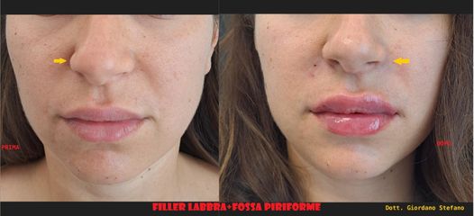 Dott. Stefano Giordano Filler Labbra