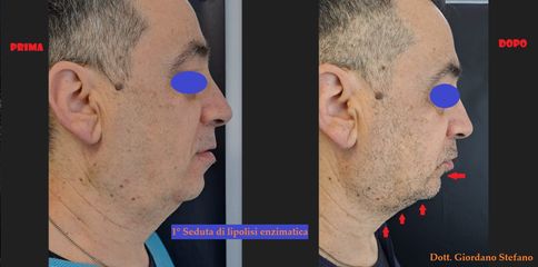 Lipolisi enzimatica per il doppio mento