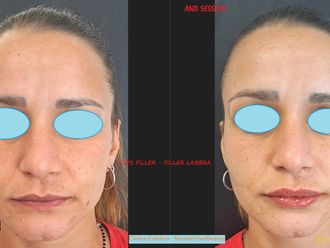 Filler labbra prima e dopo - 875723