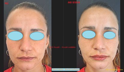 Filler Labbra - Dott. Stefano Giordano