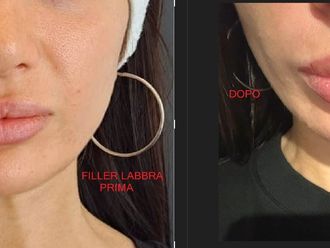Filler labbra prima e dopo - 876164