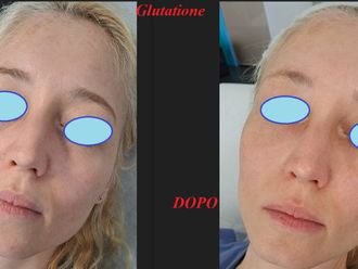 Peeling chimico prima e dopo - 876395
