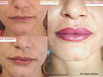 Filler labbra prima e dopo - 876396