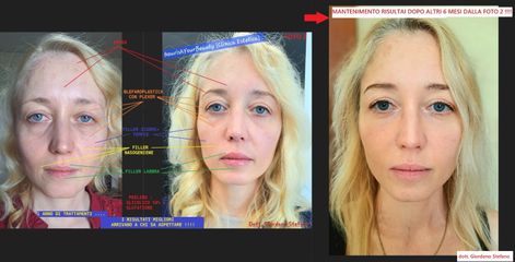 Dott. Stefano Giordano Filler