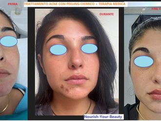 Peeling chimico prima e dopo - 877310