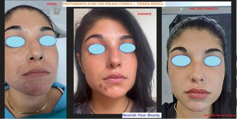 Dott. Stefano Giordano Trattamento Peeling Chimico