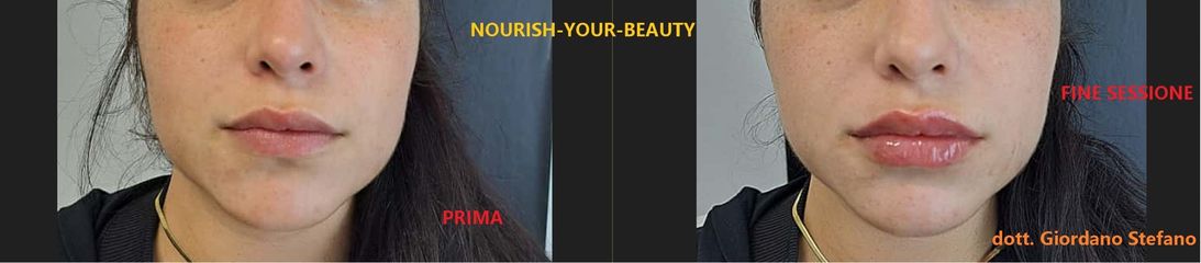Dott. Stefano Giordano trattamento Filler Labbra