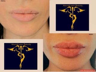 Dott. Stefano Giordano Filler Labbra