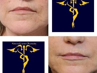 Filler prima e dopo - 877793