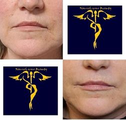 Dott. Stefano Giordano Filler regione peri-orale