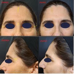 Dott. Stefano Giordano trattamento botulino duble