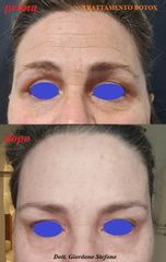 Dott. Stefano Giordano trattamento botox