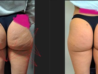 Mesoterapia prima e dopo - 878884