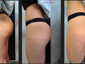 Mesoterapia prima e dopo - 878885