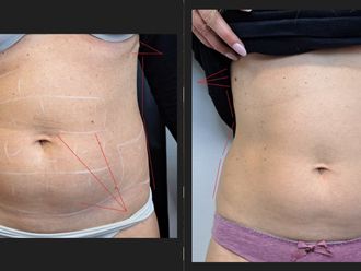 Mesoterapia prima e dopo - 878886