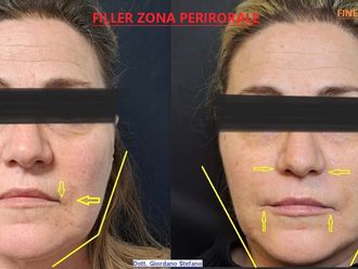 Filler prima e dopo - 879054