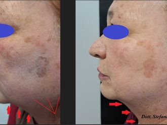 Mesoterapia prima e dopo - 879055