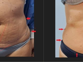 Mesoterapia prima e dopo - 879056