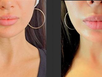 Filler labbra prima e dopo - 879266