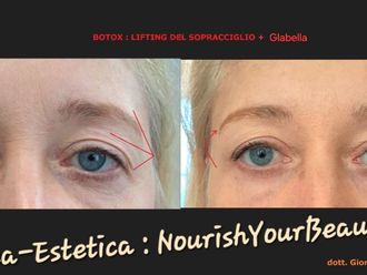 Botulino prima e dopo - 879315