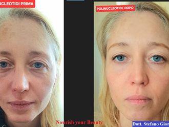 Mesoterapia prima e dopo - 879660
