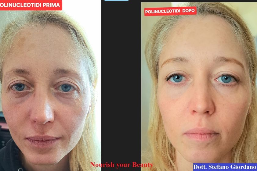 Mesoterapia prima e dopo - 879660