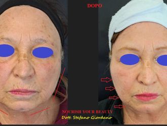 Biostimolazione prima e dopo - 879721