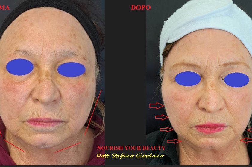 Biostimolazione prima e dopo - 879721
