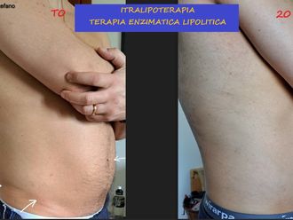 Intralipoterapia prima e dopo - 879906