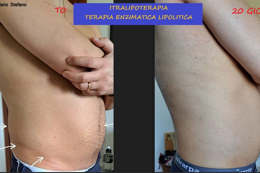 Intralipoterapia prima e dopo - 879906