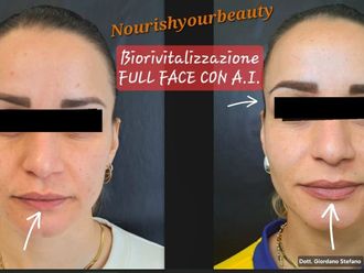 Biostimolazione prima e dopo - 880176