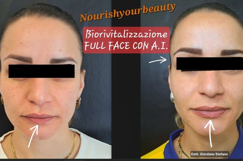 Biostimolazione prima e dopo - 880176