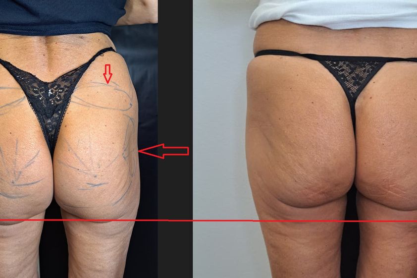 Mesoterapia prima e dopo - 881534