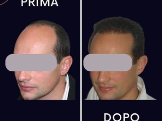 Trapianto capelli prima e dopo - 839980