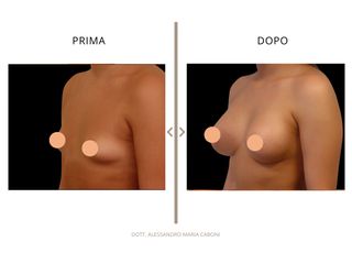 Dott. Alessandro Maria Caboni Mastoplastica additiva
