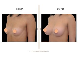 Dott. Alessandro Maria Caboni Mastoplastica additiva