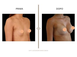Dott. Alessandro Maria Caboni Mastoplastica additiva