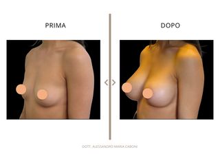 Dott. Alessandro Maria Caboni Mastoplastica additiva
