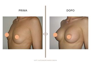 Dott. Alessandro Maria Caboni Mastoplastica additiva