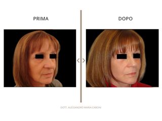 Dott. Alessandro Maria Caboni Lifting viso
