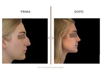 Rinoplastica prima e dopo - 878787