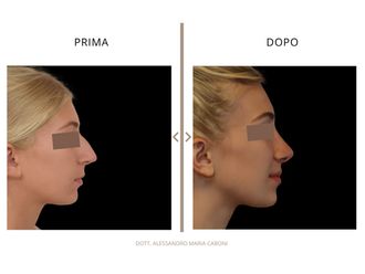 Rinoplastica prima e dopo - 878789