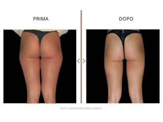 Liposuzione prima e dopo - 878790
